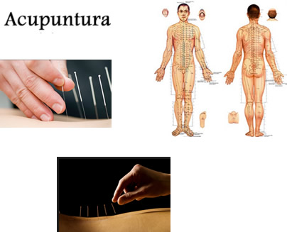 acupuntura